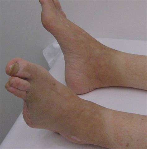 icd 10 code for cellulitis of foot|icd 10 cellulitis right thigh.